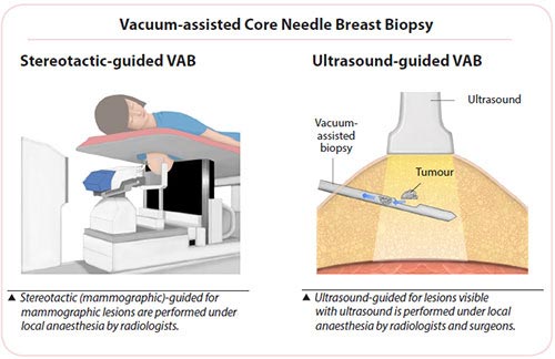 breast cancer biopsy