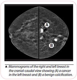 mammograms for detecting breast cancer
