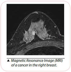 MRI of breast cancer