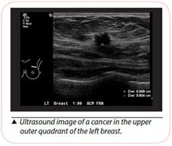 ultrasound image of breast cancer