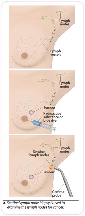 lymph node biopsy for breast cancer