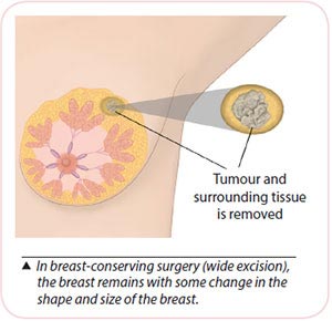 in breast conserving surgery for breast cancer