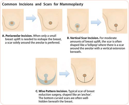 common incisions and scans for breast cancer