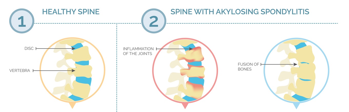 comparison of the spine with and without ankylosing spondylitis