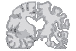 shrinkage of the brain in Dementia patients