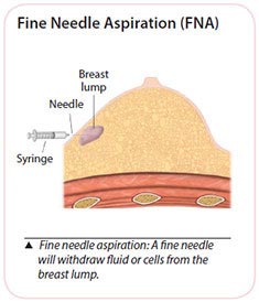 fine needle aspiration for breast cancer