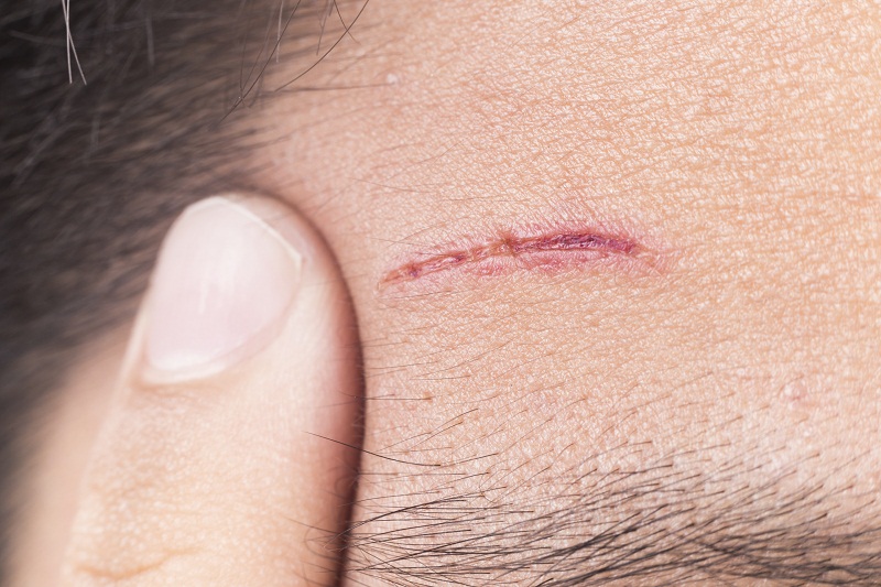 forehead_injury.jpg