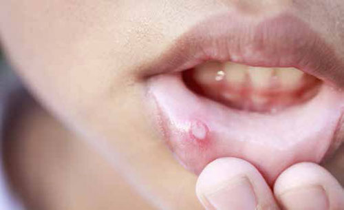 Mouth ulcers that have rolled or heaped-up edges should be viewed with a high-index of suspicion