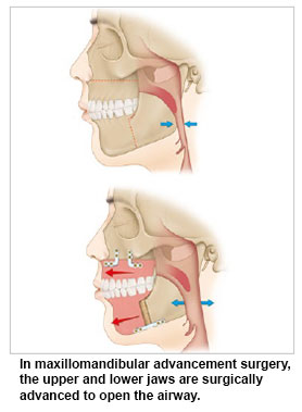 maxilomandibular advancement surgery for obstructive sleep apnoea