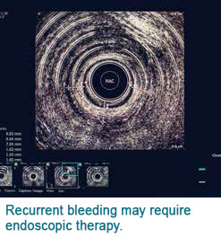 Per Rectal Bleeding Treatment Singapore General Hospital