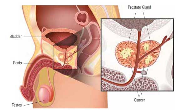 prostate gland with prostate cancer