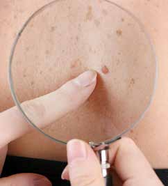 Skin cancers, lipomas and epidermoid cysts 