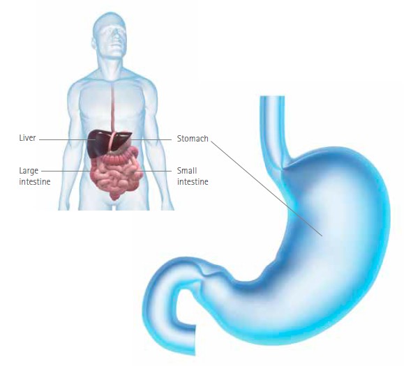 stomach affected by stomach cancer
