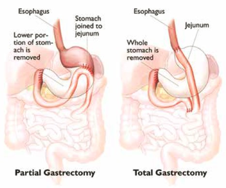 gastrectomy surgery, used to treat stomach cancer