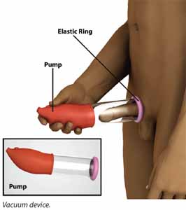 external suction device to pull blood into penis for erectile dysfunction