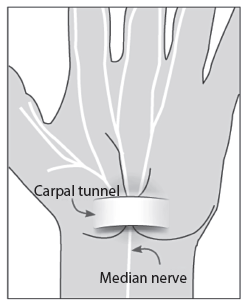 carpal tunnel syndrome in wrist