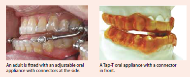 how oral appliances work for obstructive sleep apnoea